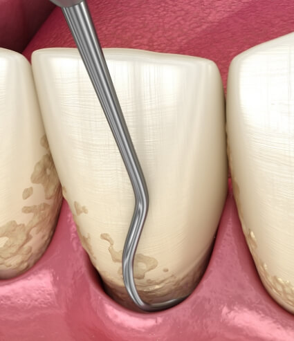 Animated dental tools removing plaque from teeth during gum disease treatment in Melbourne