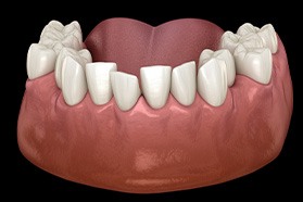 Illustration of crowded teeth in lower arch