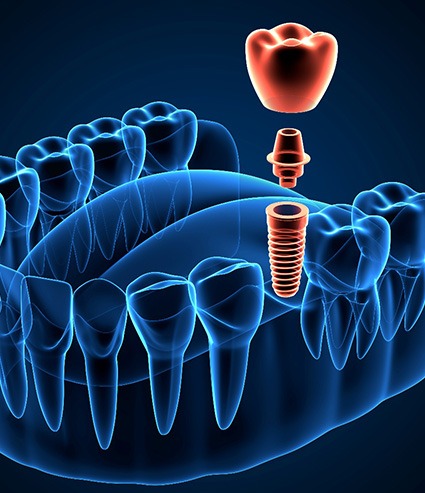 a 3D illustration showing a dental implant restoration