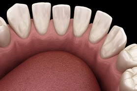 Illustration of gaps between multiple teeth