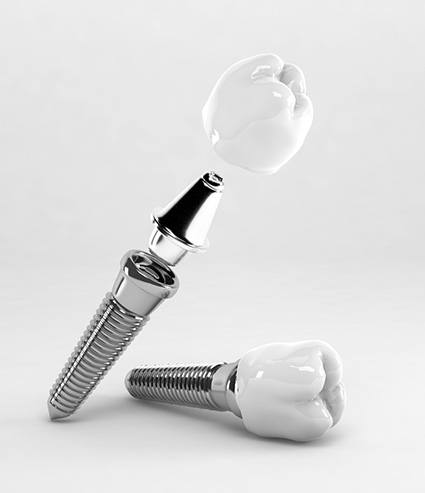 the different parts of a dental implant