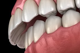 Illustrated close-up of overbite