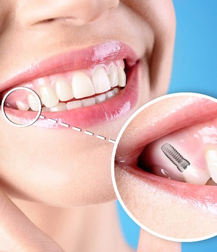 a patient with a dental implant smiling