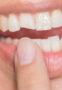 We can help repair a broken tooth near West Melbourne, FL