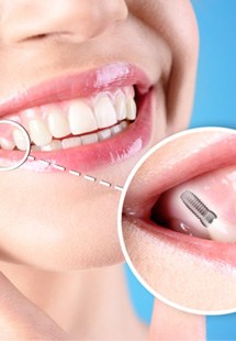 Replace missing teeth near West Melbourne, FL